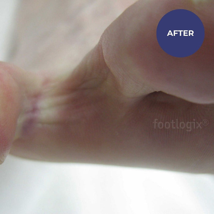 Footlogix Peeling Skin Formula Anti-Fungal Care for Peeling Feet 125ml