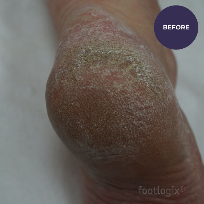 Footlogix Pedicure Callus Softener Professional Hard/Dry Skin 946ml